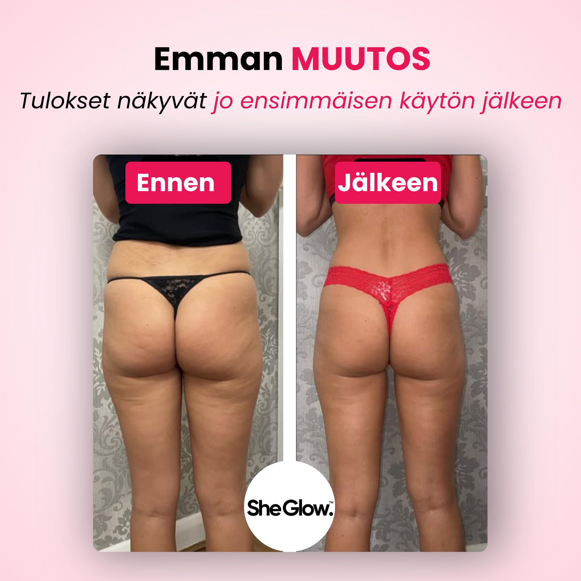 SheGlow selluliittilaitteen ennen ja jälkeen kuvat – näkyviä tuloksia jo ensimmäisen käytön jälkeen